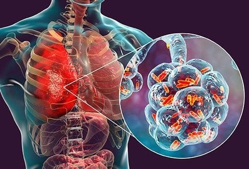 World Pneumonia Day 2023: If such problems persist for more than a week, be careful, it may be pneumonia, can take life World Pneumonia Day 2023: જો એક અઠવાડિયાથી વધુ આ સમસ્યા હોય તો સાવધાન, હોઈ શકે છે ન્યુમોનિયા, જીવનું પણ જોખમ