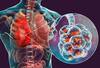 World Pneumonia Day 2023: જો એક અઠવાડિયાથી વધુ આ સમસ્યા હોય તો સાવધાન, હોઈ શકે છે ન્યુમોનિયા, જીવનું પણ જોખમ