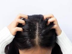 Winter: આ ઘરેલૂ ઉપાયો અપાવશે શિયાળામાં ડેન્ડ્રફથી છૂટકારો