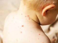 मुंबई में सामने आए खसरे के 7 नए मामले, 15 बच्चों को अस्पताल में कराया गया भर्ती