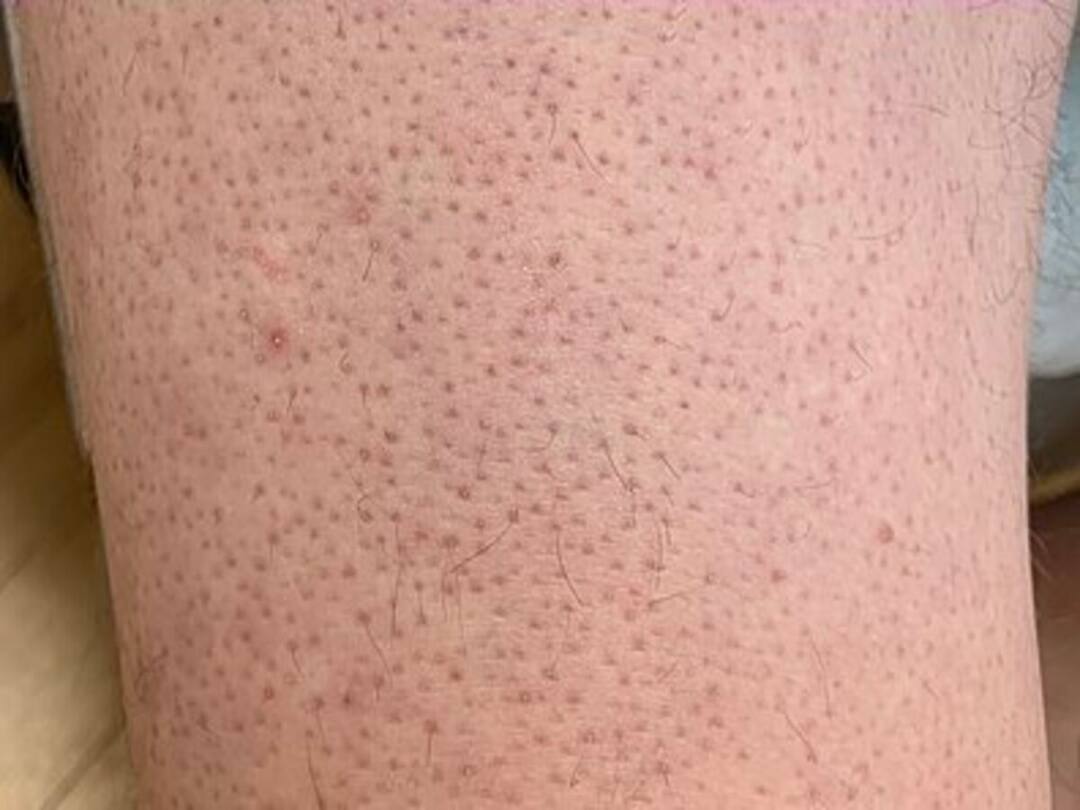 Keratosis Pilaris: சிக்கன் சருமம்போல் ஒரு நிலை.. குளிர்காலத்தில் பாதிக்குதா? என்ன செய்யலாம்?