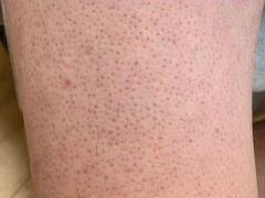 Keratosis Pilaris: சிக்கன் சருமம்போல் ஒரு நிலை.. குளிர்காலத்தில் பாதிக்குதா? என்ன செய்யலாம்?
