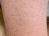 Keratosis Pilaris: சிக்கன் சருமம்போல் ஒரு நிலை.. குளிர்காலத்தில் பாதிக்குதா? என்ன செய்யலாம்?