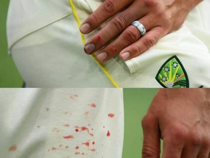 AUS vs SA: Mitchell Starc were bowling with his bleeding finger in 2nd test match against South Africa AUS vs SA: स्टार्क की उंगली से निकलता रहा खून, फिर भी करता रहा गेंदबाज़ी, दिखाया ऐसा जज़्बा