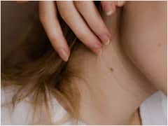 BirthMarks: పుట్టుమచ్చలు పుట్టుకతో వస్తాయా? అసలెందుకు ఇవి ఏర్పడతాయి?