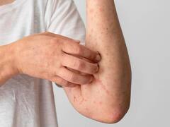 इस वजह से ठंड में बढ़ जाती है सोरायसिस की समस्या...ऐसे करें देखभाल