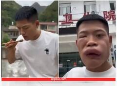 Video: ਜ਼ਿੰਦਾ ਭਰਿੰਡ ਖਾਣ ਤੋਂ ਬਾਅਦ ਮੂੰਹ ਦਾ ਹੋਇਆ ਬੁਰਾ ਹਾਲ, ਸੋਜ ਦੇਖ ਕੇ ਖੜ੍ਹੇ ਹੋ ਜਾਣਗੇ ਰੋਂਗਟੇ