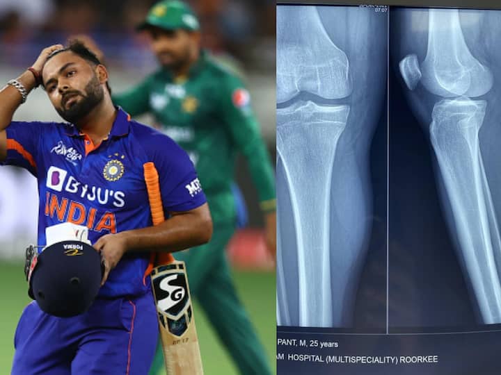 X-Ray Of Injured Rishabh Pant's Knee Surfaces After Car Crash X-Ray Of Injured Rishabh Pant's Knee Surfaces After Car Crash