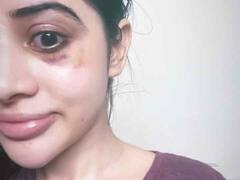 उर्फी जावेद के चहरे को ये क्या हुआ, एक्सपेरिमेंट के चक्कर में पड़ गया गहरा निशान