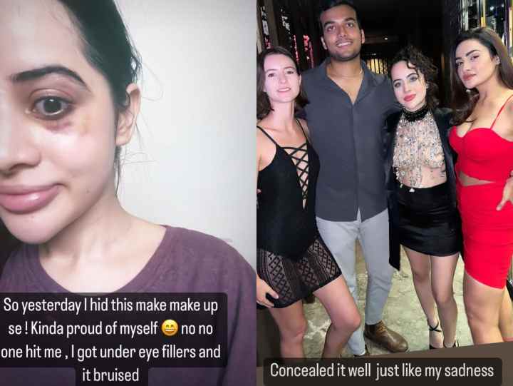 Uorfi Javed के चहरे को ये क्या हुआ, एक्सपेरिमेंट के चक्कर में पड़ गया गहरा निशान