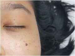 పులిపిర్లు ఎందుకు వస్తాయి? వాటిని శాశ్వతంగా తొలగించుకోవచ్చా?