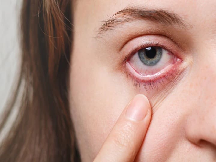 Red Eyes Infection Do you always have red eyes You will get complete relief by trying this kitchen item Red Eyes Infection: क्या आपकी हमेशा लाल रहती है आंखें? रसोई की इस चीज को आजमाने से मिलेगा एकदम आराम