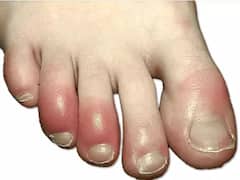 सर्दियों में आपके पैरों की उंगलियों में भी आ जाती है सूजन, करें ये काम तुरंत मिलेगी राहत