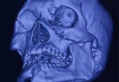 चेहरे पर 16 फ्रैक्चर, टूटी खोपड़ी, कट चुकी जीभ... फिर डॉक्टरों ने किया कुछ ऐसा चमत्कार