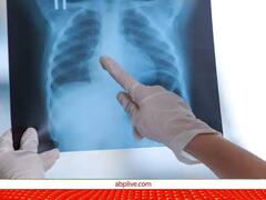 एमपी में एक लाख 64 हजार टीबी के मरीज खतरे में, जुगाड़ की दवा के सहारे चल रहा इलाज