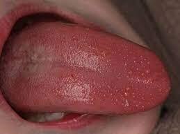 জিভে ঘা হলে , তাকে বলে গ্লসাইটিস (glossitis)।  জিভ লাল হয়ে গেলে তাকে বলে অ্যাঙ্গরি লুকিং টাং।