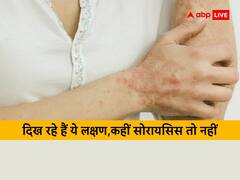 सोरायसिस से बचके...घुटने, कोहनी, खोपड़ी, पीठ और स्किन पर दिखे ऐसे लक्षण तो हो जाएं सावधान !