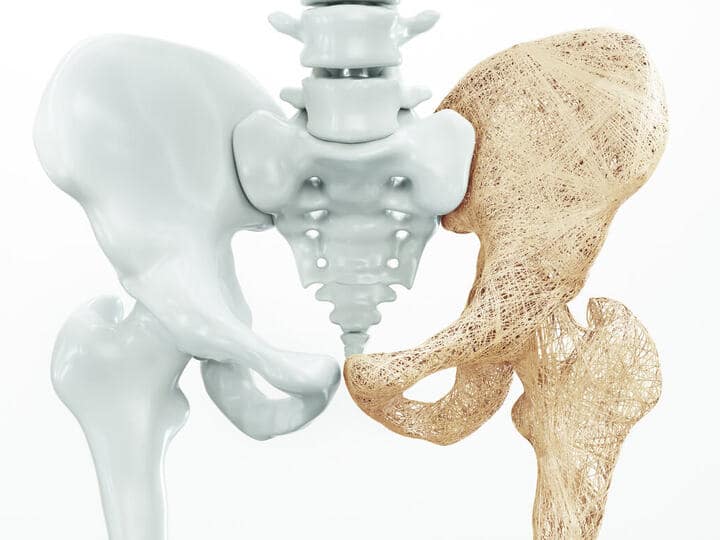how to increase bone density उठने बैठने में हड्डियों से आती है कट-कट की आवाज...समझ जाइए बोन डेंसिटी हो रही है कम... ऐसे रखें ख्याल