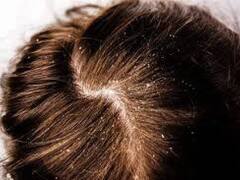 இந்த விஷயத்தை பின்பற்றினால் குளிர்காலத்தில் பொடுகு வராமல் தடுக்கலாம்!