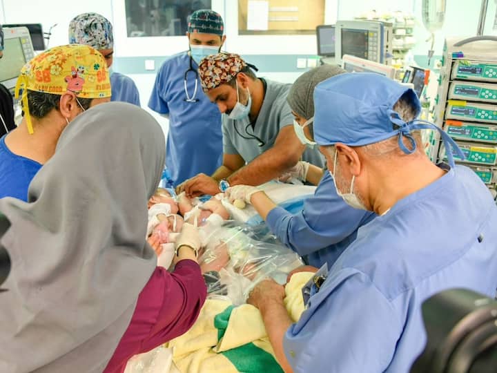 Iraqi Conjoined Twins separated by Saudi Arabia Doctors After 11 Hour Long Surgery Know Details Conjoined Twins: సౌదీలో అరుదైన శస్త్రచికిత్స, అవిభక్త కవలల్ని వేరు చేసిన వైద్యులు - 11 గంటల పాటు సర్జరీ