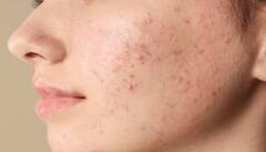 स्किन से जुड़ी इन 6 समस्याओं से राहत दे सकता है आलू का दूध...आज ही जान लें