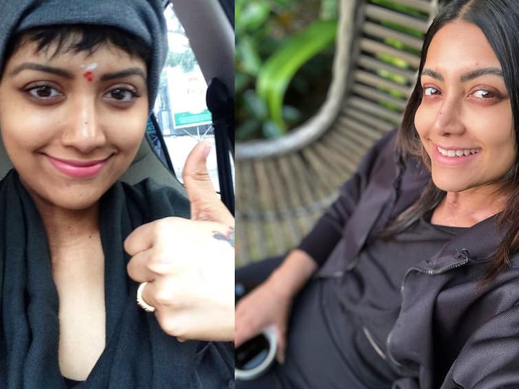 acress Mamta Mohandas diagnosed with autoimmune disorder called vitiligo shares note on embracing the journey Mamta Mohandas: கேன்சரை போராடி வென்ற மம்தாவுக்கு மீண்டும் அரிய வகை நோய்... கவலையில் ரசிகர்கள்!