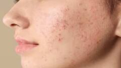 ਸਕਿਨ ਨਾਲ ਜੁੜੀਆਂ ਇਨ੍ਹਾਂ ਸਮੱਸਿਆਵਾਂ ਨੂੰ ਦੂਰ ਕਰ ਸਕਦਾ ਆਲੂ ਦਾ ਦੁੱਧ….ਜਾਣੋ