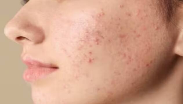 ਆਲੂ ਦੇ ਦੁੱਧ ਵਿਚ ਮੌਜੂਦ ਐਂਟੀ-ਇੰਫਲੇਮੇਟਰੀ (anti-inflammatory) ਗੁਣ ਸਕਿਨ 'ਤੇ ਹੋਣ ਵਾਲੇ ਕਿਲ ਮੁਹਾਸਿਆਂ ਤੋਂ ਛੁਟਕਾਰਾ ਦਿਵਾਉਂਦੀ ਹੈ, ਇਹ ਸਕਿਨ 'ਤੇ ਜਮ੍ਹਾਂ ਹੋਈ ਗੰਦਗੀ ਅਤੇ ਐਕਸਟ੍ਰਾ ਆਇਲ ਨੂੰ ਦੂਰ ਕਰਨ ਵਿਚ ਮਦਦ ਕਰਦਾ ਹੈ।