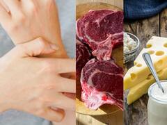 Psoriasis allergy foods : சொரியாசிஸ் இருப்பவர்கள் தவிர்க்க வேண்டிய உணவுகள்!