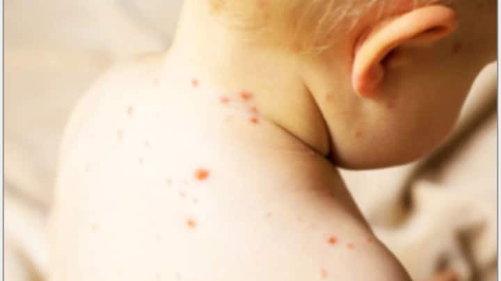 Measles And Food:কোভিড-সংক্রমণের আড়ালে গত বছর পাল্লা দিয়ে বেড়েছে মিসলস। কিন্তু অতিমারি মোকাবিলায় ব্যস্ত থাকায় বহু সময়ই এর ব্যাপকতা তেমন ভাবে বুঝে উঠতে পারিনি আমরা।