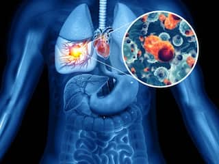 5 Signs Of Respiratory Health and Lung Cancer know the Symptoms, Myths and Treatment Lung Cancer:  ફેફસાનું કેન્સર કેમ થાય છે? જાણો લક્ષણો, સારવાર, દવા