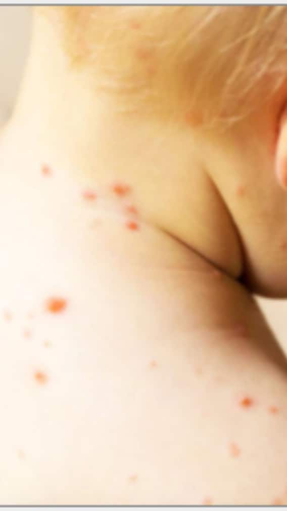 মিসলসে কী ভাবে খাওয়াদাওয়া করবেন?