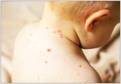 Health News:মিসলস সংক্রমণ থেকে সেরে উঠছেন? কী খাবেন? কী বাদ দেবেন?