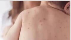 Health News:মিসলস সংক্রমণ থেকে সেরে উঠছেন? কী খাবেন? কী বাদ দেবেন?