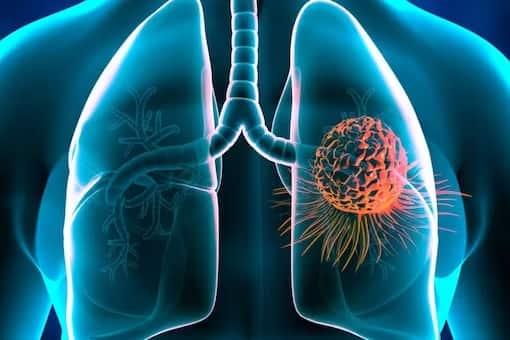 Lung Cancer 5 Signs Of Respiratory Health and Lung Cancer know the Symptoms, Myths and Treatment Lung Cancer : फुफ्फुसाचा कर्करोग नेमका कशामुळे होतो? जाणून घ्या लक्षण, कारण आणि उपचार
