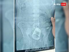 पत्नी को मायके से लाने गए शख्स के साथ ससुराल वालों ने की मारपीट, प्राइवेट पार्ट में घुसा दिया ग्लास