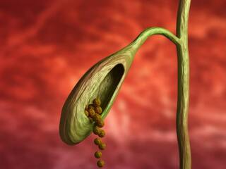 Health News : कावीळ झाल्यास योग्य उपचार घ्या, मुंबईत 30 वर्षीय महिलेच्या पित्ताशयातून काढले 30 खडे