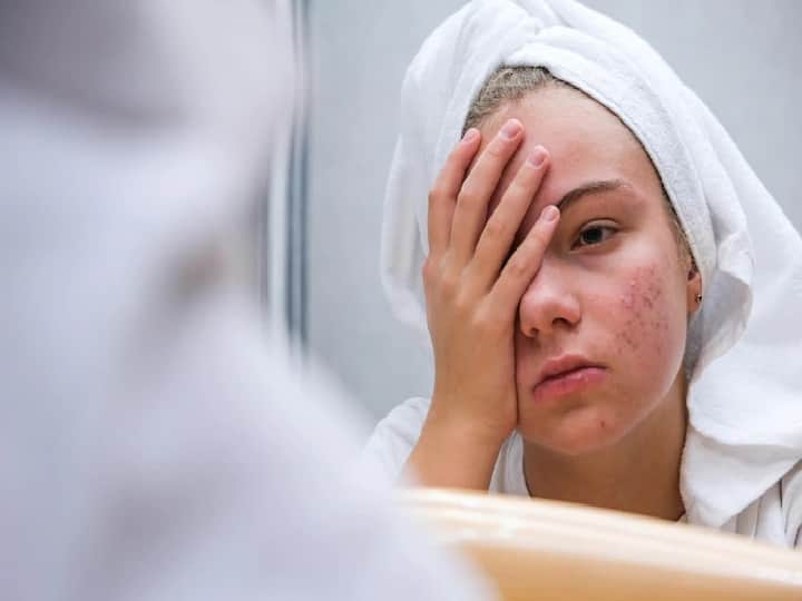 Symptoms of PCOS Do not ignore these problems on the face there can be signs of PCOS Symptoms Of PCOS: चेहरे पर होने वाली इन समस्याओं को ना करें अनदेखा, हो सकते हैं पीसीओएस के संकेत