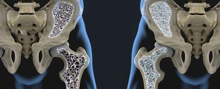 बोन मिनिरल डेंसिटी का टेस्ट करवाएं इससे पता चलता है कि कहीं आप की हड्डी घिस तो नहीं रही है और इसी वजह से तो आपको दर्द नहीं हो रहा है. हड्डियों की डेंसिटी पता होने पर इनकी कमजोरी का पता चल जाता है और फिर इस हिसाब से इलाज चलता है.