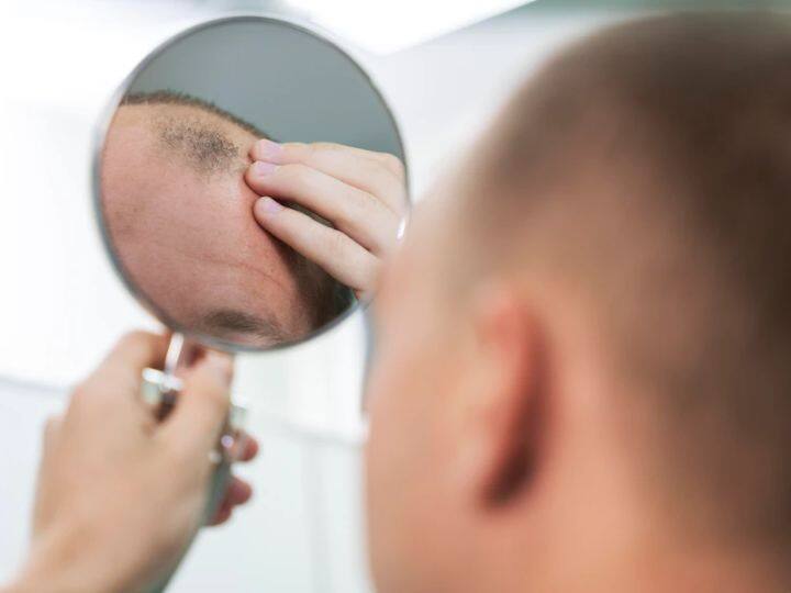 Men who drink energy drinks, sweetened coffee and tea on a daily basis lose hair – Research