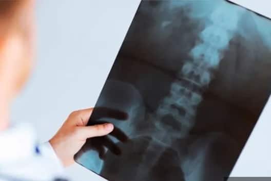 हड्डियों में बहुत ज्यादा दर्द है इसके लिए एक्स-रे करवाएं, इससे पता चल जाएगा कि कहीं आपकी हड्डी डैमेज तो नहीं हो गई है.