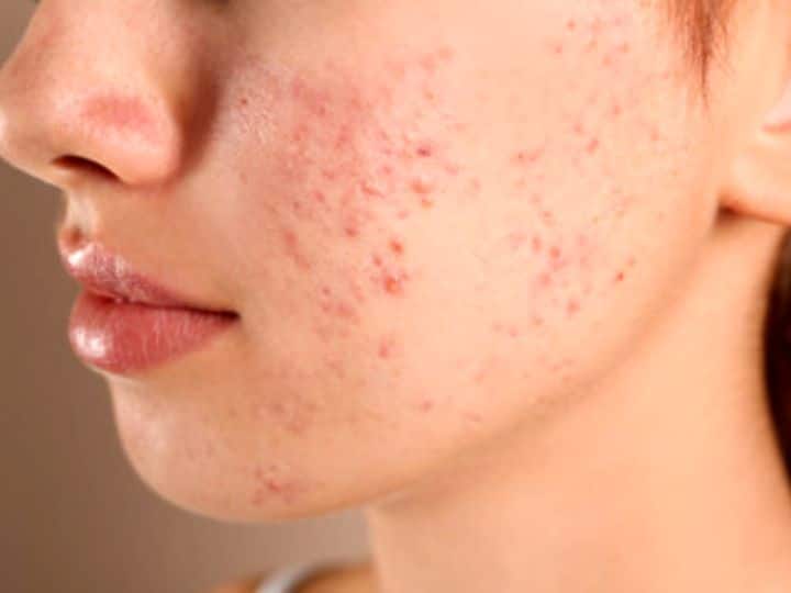 How to Remove Acne From Skin Know Food Fruits Products That Really Work किन वजहों से होते हैं 'पिंपल्स'? जानें कैसे इस मुसीबत से पाएं निजात