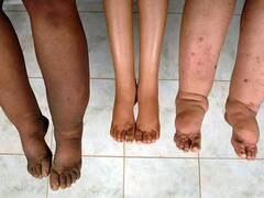 बलिया समेत यूपी के 51 जिलों में फाइलेरिया ने लिया महामारी का रूप, जानें जिले में कब से चलेगा अभियान  