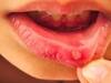 ਜੇਕਰ 10 ਦਿਨਾਂ ਬਾਅਦ ਮੂੰਹ 'ਚ ਹੋ ਰਹੇ ਛਾਲੇ ਤਾਂ ਹੋ ਜਾਓ ਸਾਵਧਾਨ! ਇਨ੍ਹਾਂ ਮੁਸ਼ਕਿਲਾਂ ਦਾ ਕਰਨਾ ਪੈ ਸਕਦਾ ਸਾਹਮਣਾ