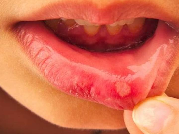 Every 10 days there are blisters in the mouth, so be careful