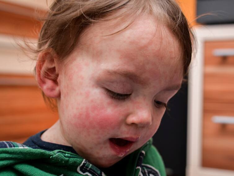 Measles Outbreak: All That You Need To Know About The Contagious Disease Measles Outbreak: All That You Need To Know About The Contagious Disease