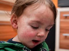Measles Outbreak: All That You Need To Know About The Contagious Disease