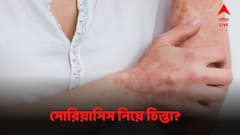 শীতে বাড়ছে সোরিয়াসিস? মোকাবিলায় পরামর্শ ডাক্তারদের