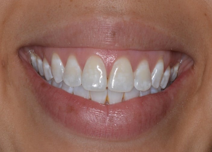 White Spots on Teeth Do not take lightly the white spots on the teeth, here are the ways to get rid of them easily White Spots on Teeth: दांतों पर हो रहे सफेद धब्बों को हल्के में ना लें, यहां जानें आसानी से छुटकारा पाने के उपाय