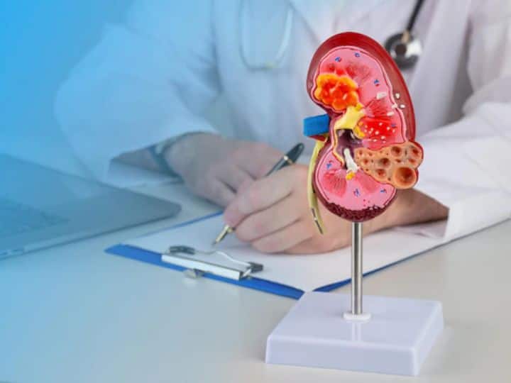 Kidney Stone Patients Should Avoid These Food Drinks Kidney Stone: किडनी स्टोन के मरीज भूलकर भी न खाएं ये चीजें, बढ़ सकती है परेशानी